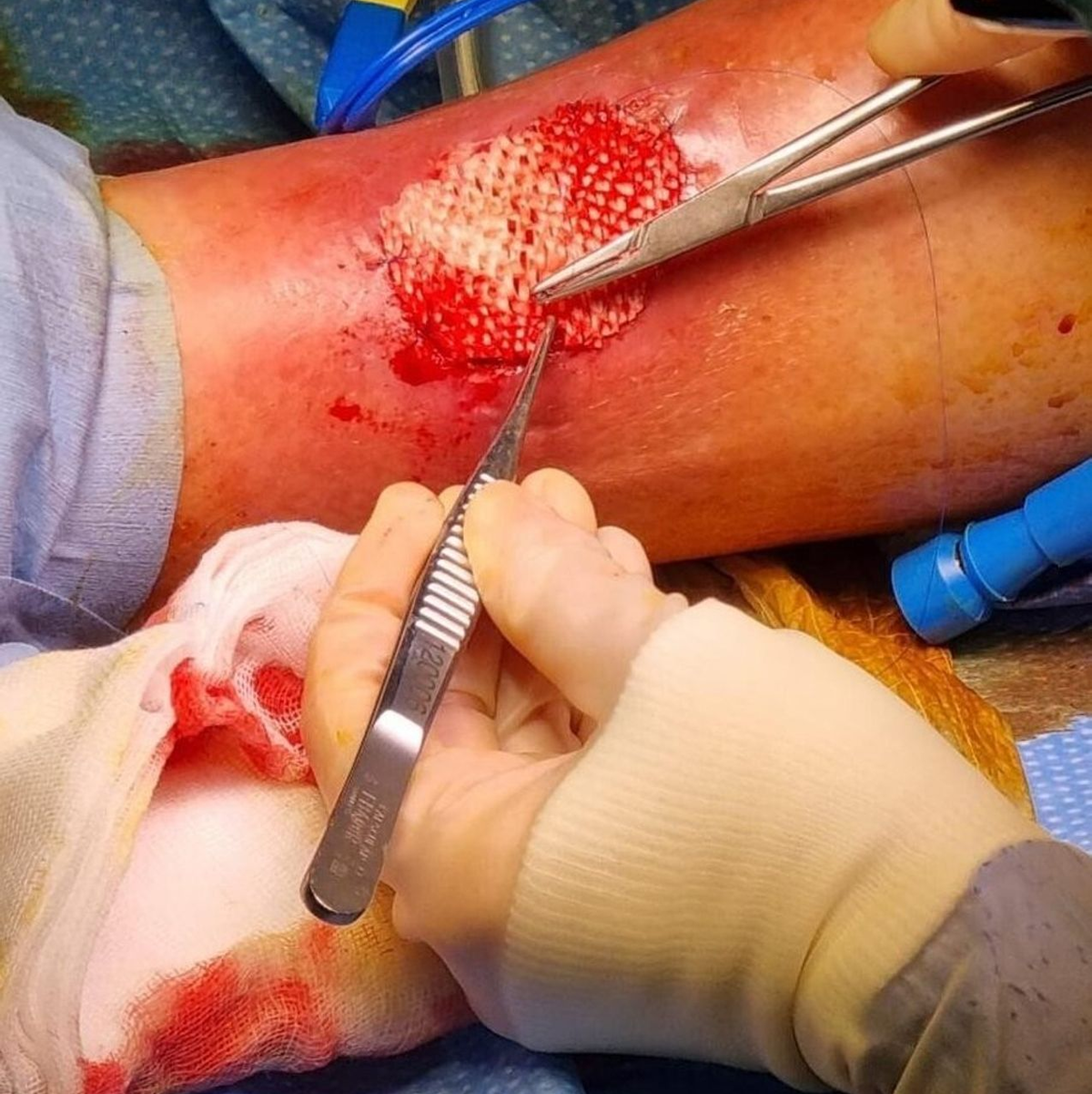 Das Omega-3 in der Fischhaut fördert die Heilung großer Wunden.  - Foto: Saziye Karaca/-/dpa