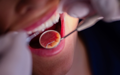 Zahnarztbehandlungen sollen nach dem Willen des CDU-Wirtschaftsrats «nicht länger im Umlageverfahren den Beitragszahlern zur Last fallen». (Symbolbild) - Foto: Rolf Vennenbernd/dpa Zahnarztbehandlungen sollen nach dem Willen des CDU-Wirtschaftsrats «nicht länger im Umlageverfahren den Beitragszahlern zur Last fallen». (Symbolbild) - Foto: Rolf Vennenbernd/dpa