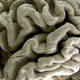 Das Gehirn eines Alzheimer-Patienten zeigt tiefe Furchen. (Illustration) - Foto: David Duprey/AP/dpa