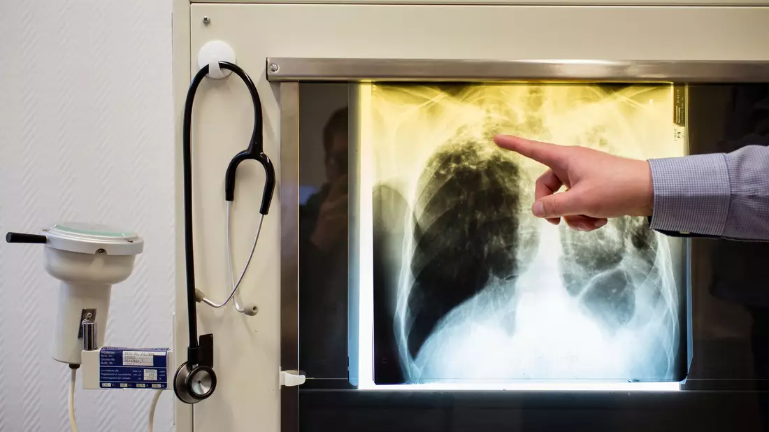 Tuberkulose-Erkrankungen werden in Europa oft nicht erkannt. (Illustration) - Bild: Gregor Fischer/Deutsche Presse-Agentur GmbH/dpa