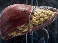 Fettleber: Die stille Epidemie erfasst Deutschland - Foto: über boerse-global.de