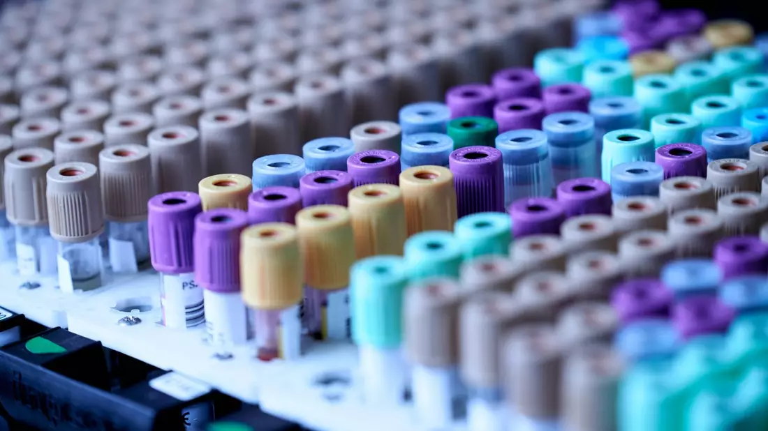 Aktuelle Untersuchung zeigt: Ein frühzeitiger Einsatz von schneller Labordiagnostik könnte in Deutschland jährlich rund 3.800 Todesfälle durch Sepsis vermeiden und ca. 153 Millionen Euro einsparen - Bild: presseportal.de
