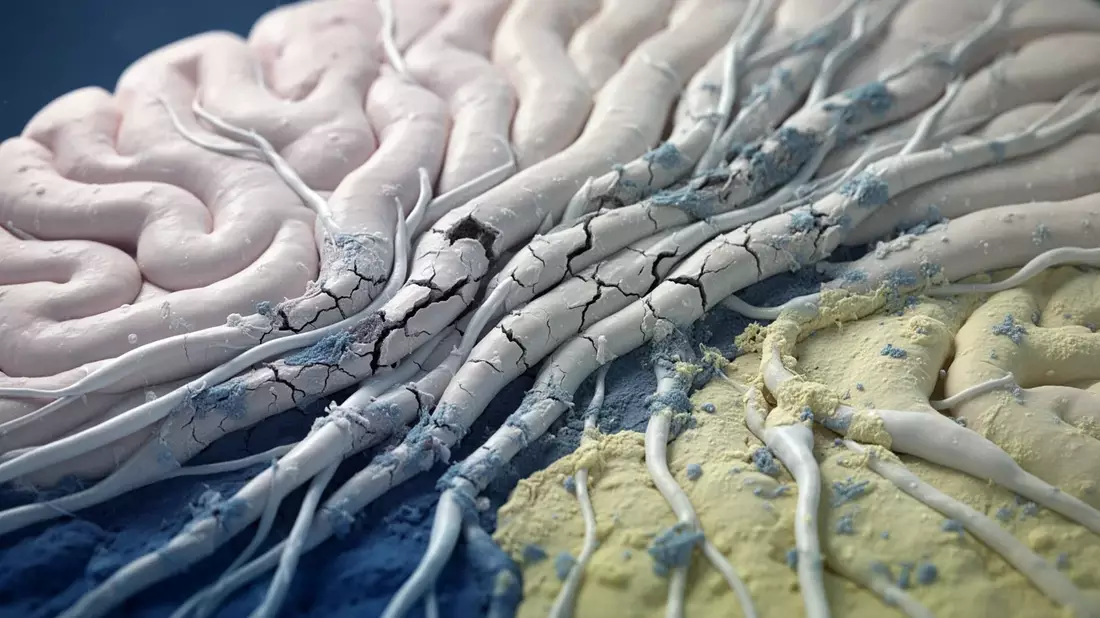 Myelinschäden: Neue Parkinson-Theorie erschüttert Hirnforschung - Bild: über boerse-global.de