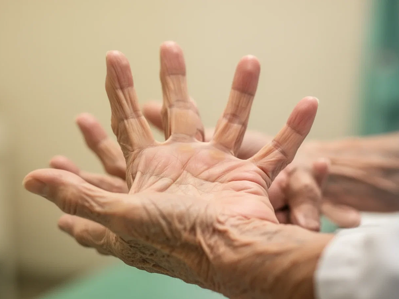 Bewegung statt Schonung: Moderne Handtherapie setzt auf KI und Training - Foto: über boerse-global.de