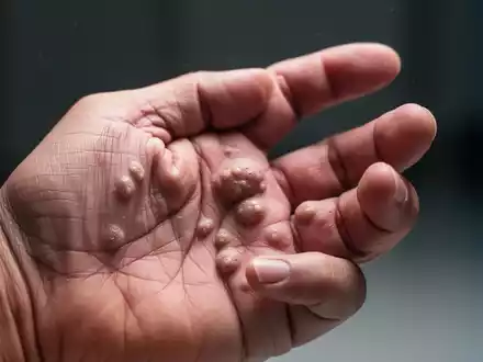 Nahaufnahme einer Hand mit Dupuytren-Kontraktur, die sichtbare Knoten und einen leicht gekrümmten Finger zeigt. - Foto: über boerse-global.de