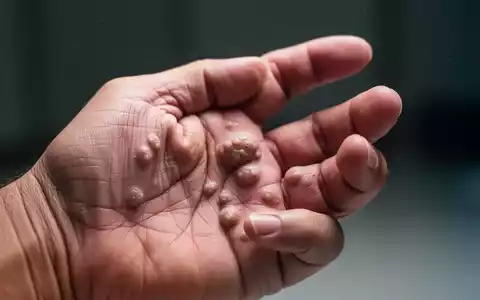 Nahaufnahme einer Hand mit Dupuytren-Kontraktur, die sichtbare Knoten und einen leicht gekrümmten Finger zeigt. - Foto: über boerse-global.de
