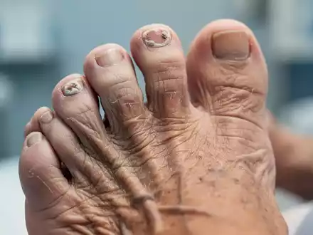 Nahaufnahme des Fußes einer älteren Person mit Fokus auf die Zehennägel; einer zeigt Anzeichen von Nagelpilz. - Foto: über boerse-global.de