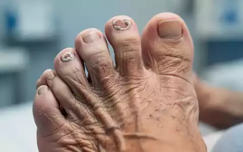 Nahaufnahme des Fußes einer älteren Person mit Fokus auf die Zehennägel; einer zeigt Anzeichen von Nagelpilz. - Foto: über boerse-global.de