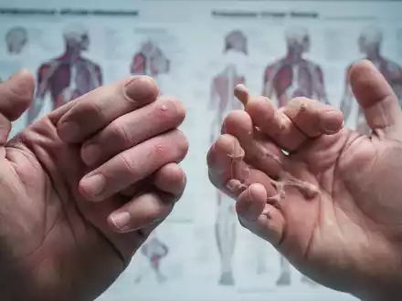 Nahaufnahme von Händen, die die Unterschiede zwischen rheumatischen und arthrotischen Gelenken durch Schwellung und knöcherne Veränderungen zeigen. - Foto: über boerse-global.de