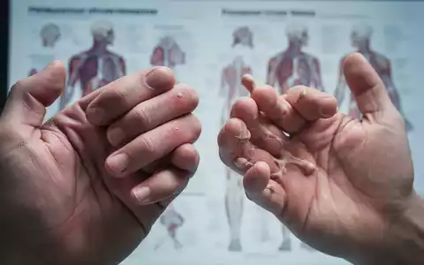 Nahaufnahme von Händen, die die Unterschiede zwischen rheumatischen und arthrotischen Gelenken durch Schwellung und knöcherne Veränderungen zeigen. - Foto: über boerse-global.de