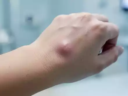 Nahaufnahme einer menschlichen Hand mit einem kleinen, kaum sichtbaren Überbein am Handgelenk. - Foto: über boerse-global.de