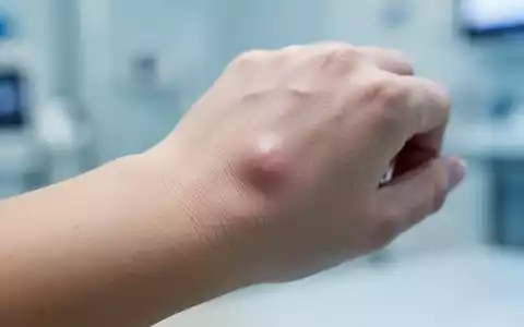 Nahaufnahme einer menschlichen Hand mit einem kleinen, kaum sichtbaren Überbein am Handgelenk. - Foto: über boerse-global.de