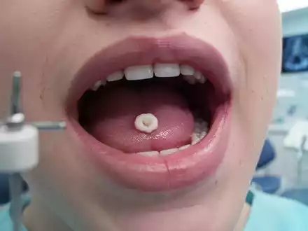 Nahaufnahme einer Aphte auf der Innenseite einer Lippe, die einen kleinen, weißen Bereich der Entzündung zeigt. - Foto: über boerse-global.de