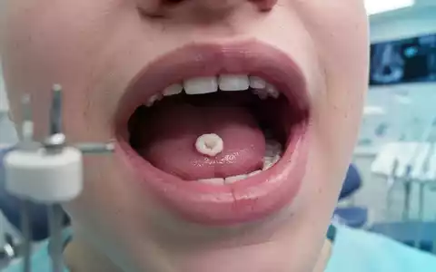Nahaufnahme einer Aphte auf der Innenseite einer Lippe, die einen kleinen, weißen Bereich der Entzündung zeigt. - Foto: über boerse-global.de