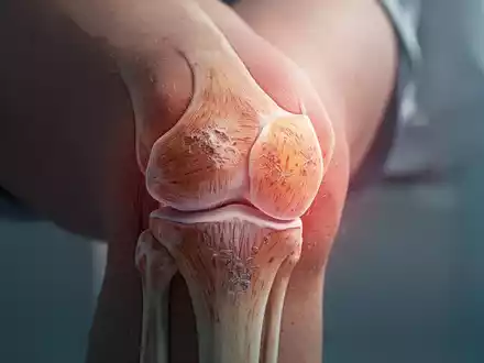 Nahaufnahme eines menschlichen Kniegelenks, das subtile Anzeichen von Verschleiß oder frühen arthritischen Veränderungen aufweist. - Foto: über boerse-global.de