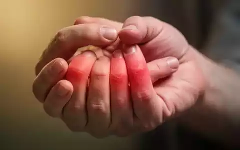 Nahaufnahme einer Hand, die schmerzende Fingergelenke berührt, symbolisiert rheumatische Arthritis und chronische Schmerzen. - Foto: über boerse-global.de