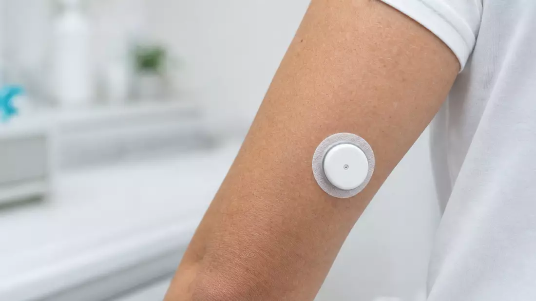 Fotorealistischer CGM-Sensor-Patch am Arm, klinisches Umfeld, Medizintechnik
