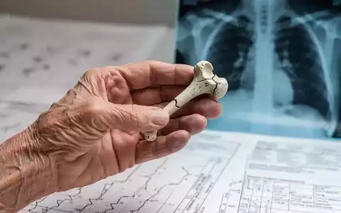 Eine Nahaufnahme einer älteren, zerbrechlichen Hand, die ein kleines, gebrochenes Knochenmodell hält. Im Hintergrund sind medizinische Diagramme zu sehen. - Foto: über boerse-global.de