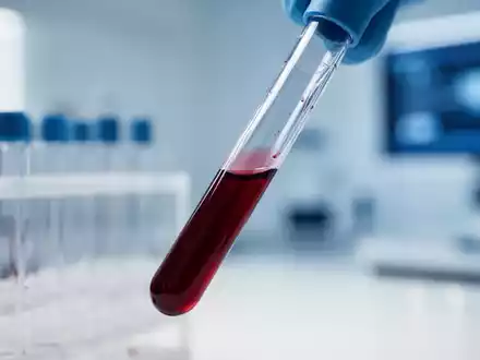 Blutprobe in einem medizinischen Labor zur Alzheimer-Früherkennung. - Foto: über boerse-global.de