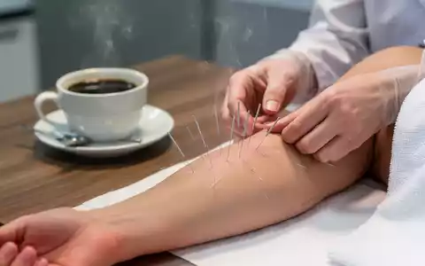 Akupunkturnadeln an einem Patientenarm neben einer Tasse Kaffee in einer medizinischen Praxis. - Foto: über boerse-global.de