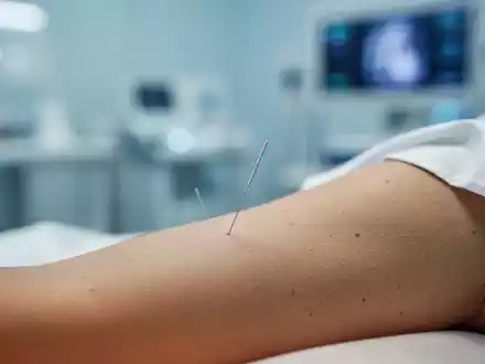 Nahaufnahme einer Akupunkturnadel bei einer medizinischen Behandlung in einer klinischen Umgebung. - Foto: über boerse-global.de