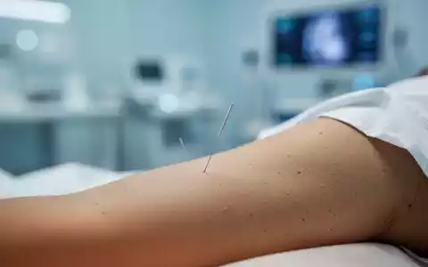 Nahaufnahme einer Akupunkturnadel bei einer medizinischen Behandlung in einer klinischen Umgebung. - Foto: über boerse-global.de