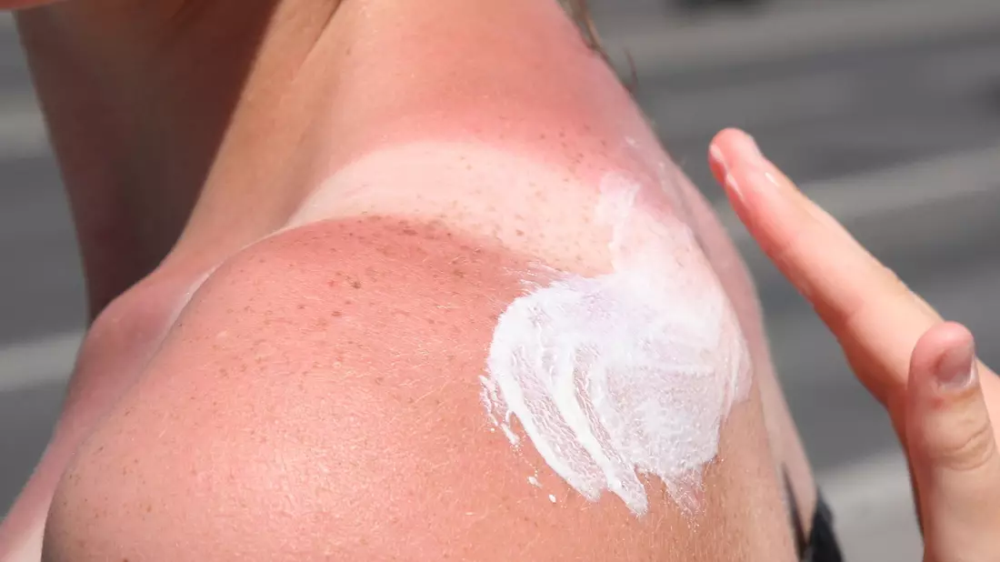 Sonnenbrand ist gefährlich - es drohen Langzeitfolgen. - Bild: Stephanie Pilick/dpa/dpa-tmn