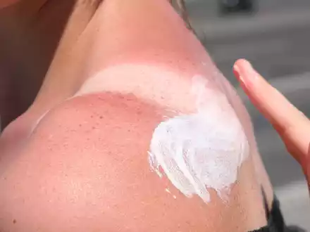 Sonnenbrand ist gefährlich - es drohen Langzeitfolgen. - Foto: Stephanie Pilick/dpa/dpa-tmn