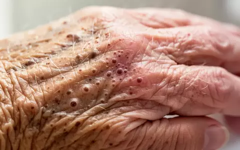 Nahaufnahme der Hautstruktur einer älteren Person bei natürlichem Tageslicht. - Foto: über boerse-global.de