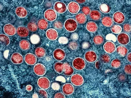 Die eitrigen Pusteln können am ganzen Körper auftreten und sehr schmerzhaft sein. (Symbolbild) - Foto: -/National Institute of Allergy and Infectious Diseases/dpa