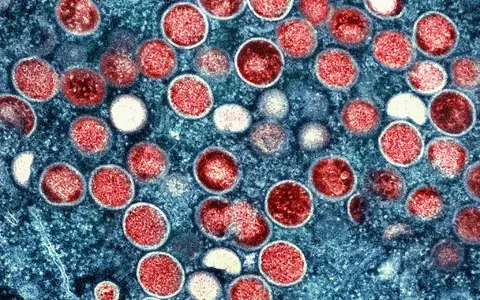 Die eitrigen Pusteln können am ganzen Körper auftreten und sehr schmerzhaft sein. (Symbolbild) - Foto: -/National Institute of Allergy and Infectious Diseases/dpa