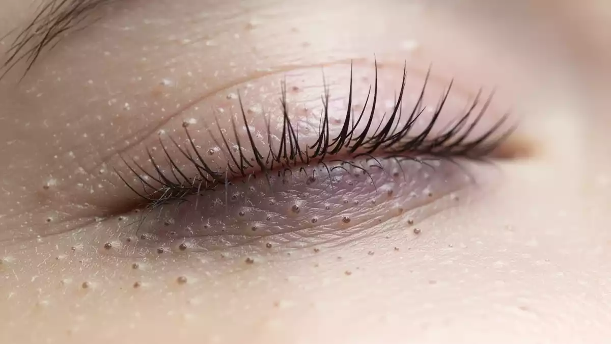 Wimpernverlängerungen: Studie zeigt Augenreizungen und Drüsenprobleme