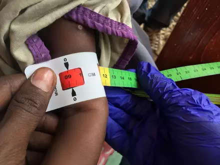 Schon jetzt gelten fast zwei Millionen Kinder in Somalia akut unterernährt. (Archivbild) - Foto: Eva-Maria Krafczyk/dpa