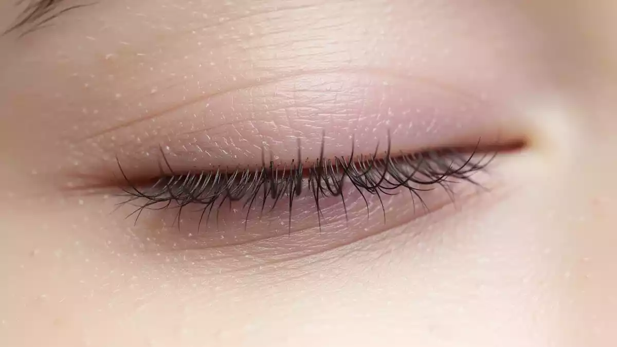 Demodex-Milben am Auge: Häufiger Befall erschwert die Diagnose