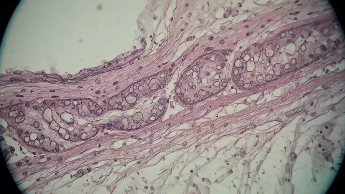 Charité-Forschung zeigt, wie Helicobacter pylori Magenkrebs begünstigt