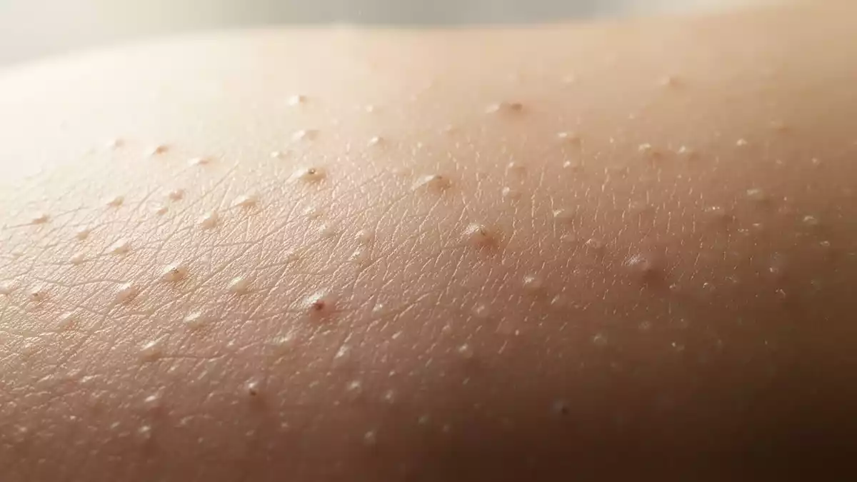 Johnson & Johnson erhält EU-Zulassung für orale Psoriasis-Tablette