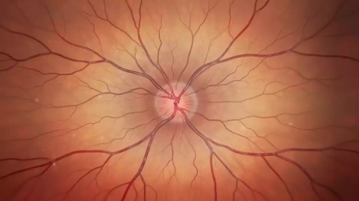 Aitheroscope: KI erkennt Atherosklerose in Netzhautbildern