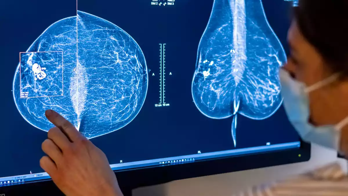 Mit einer Mammografie untersuchen Ärzte die Brust einer Frau auf Brustkrebs - nun gelten geänderte Regeln. (Symbolfoto) - Bild: Hannibal Hanschke/dpa