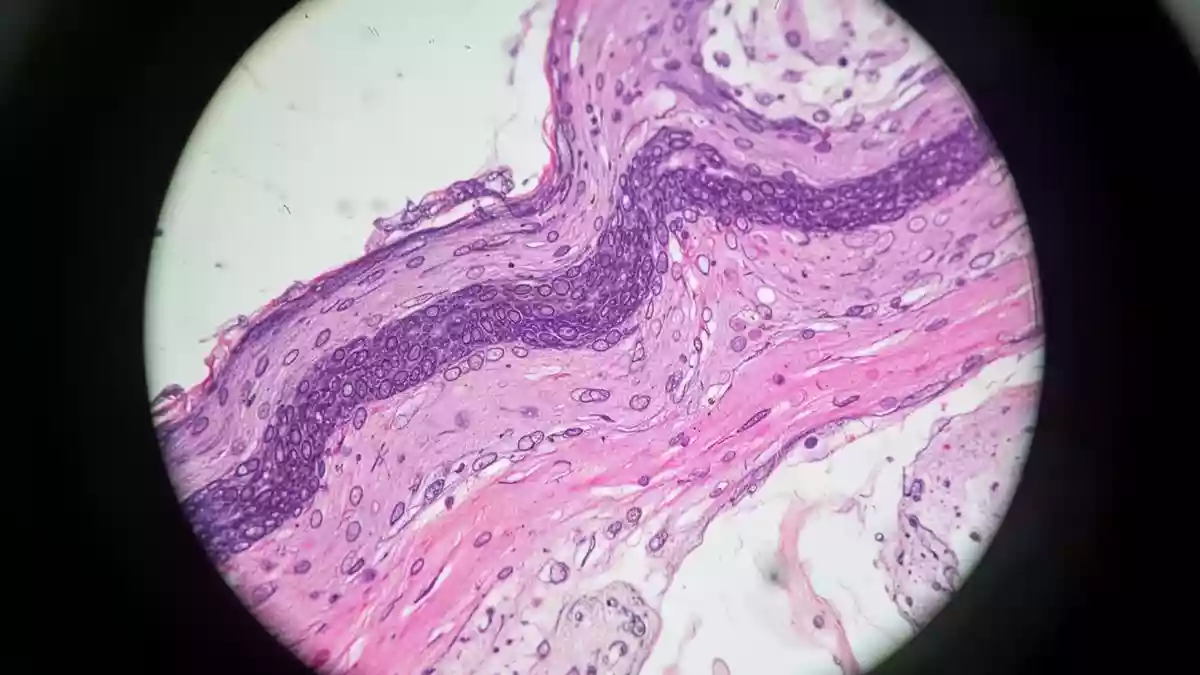 Prostatakrebs: KI kombiniert Biopsiebilder mit klinischen Daten