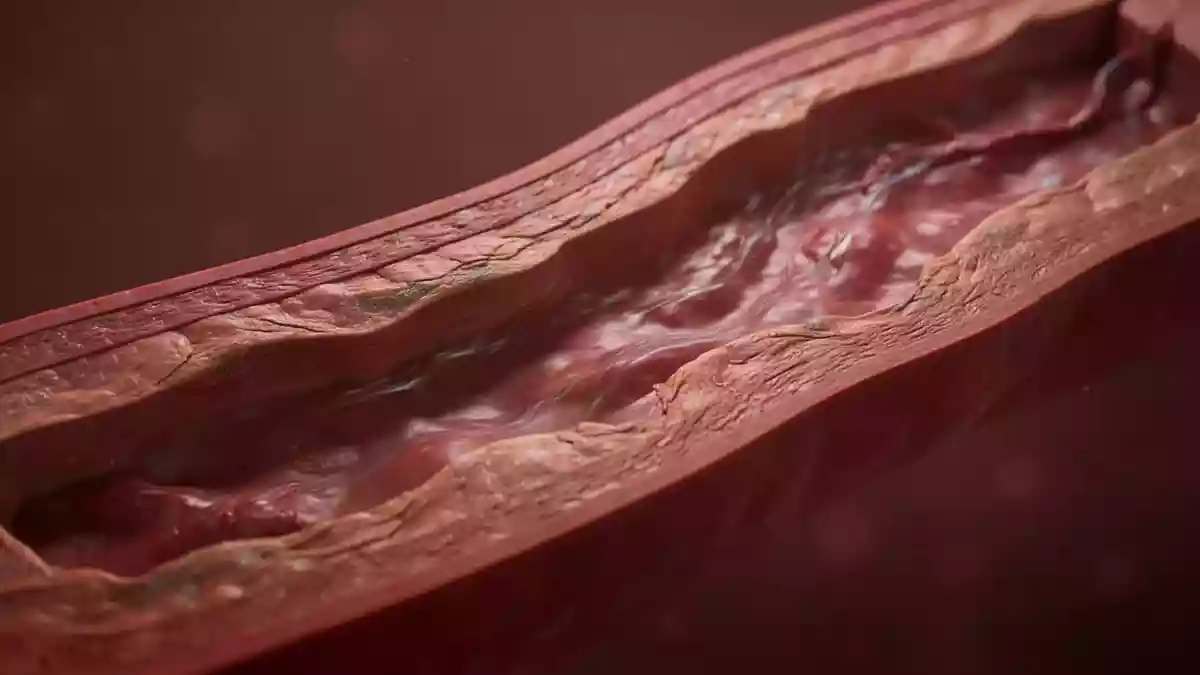 LDL-Cholesterin und Herzrisiko: Weitere Blutfette erhöhen das Restrisiko