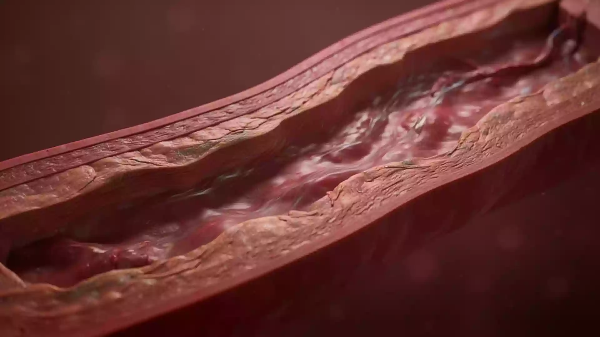 LDL-Cholesterin: Zielwerte unter 100, 70 oder 55 mg/ dl je nach Risiko - ad-hoc-news.de