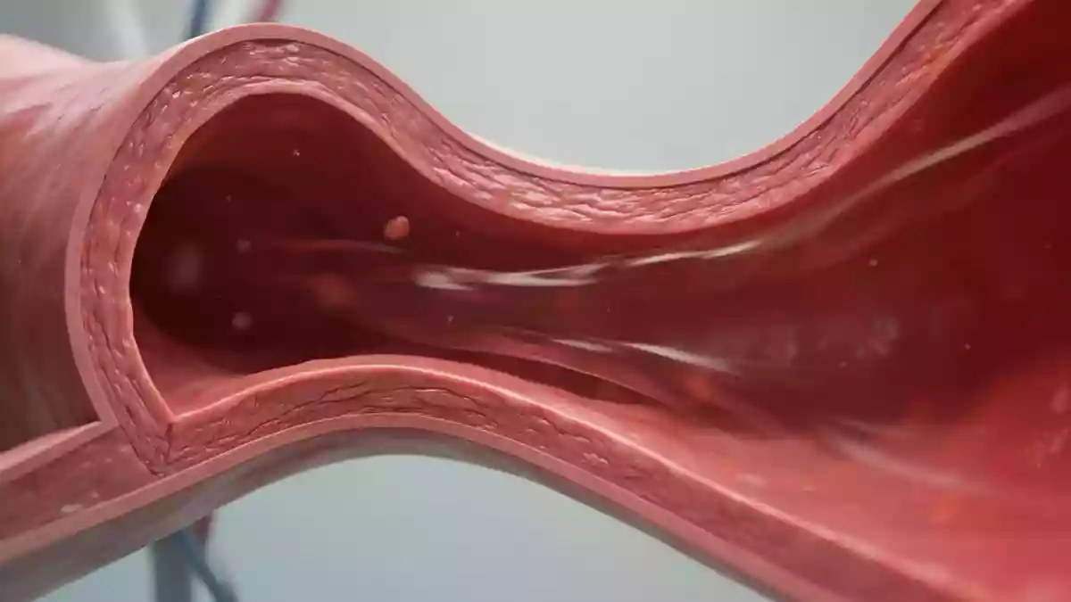 Hyperlipidämie: Experten empfehlen frühen Start mit Kombinationstherapie