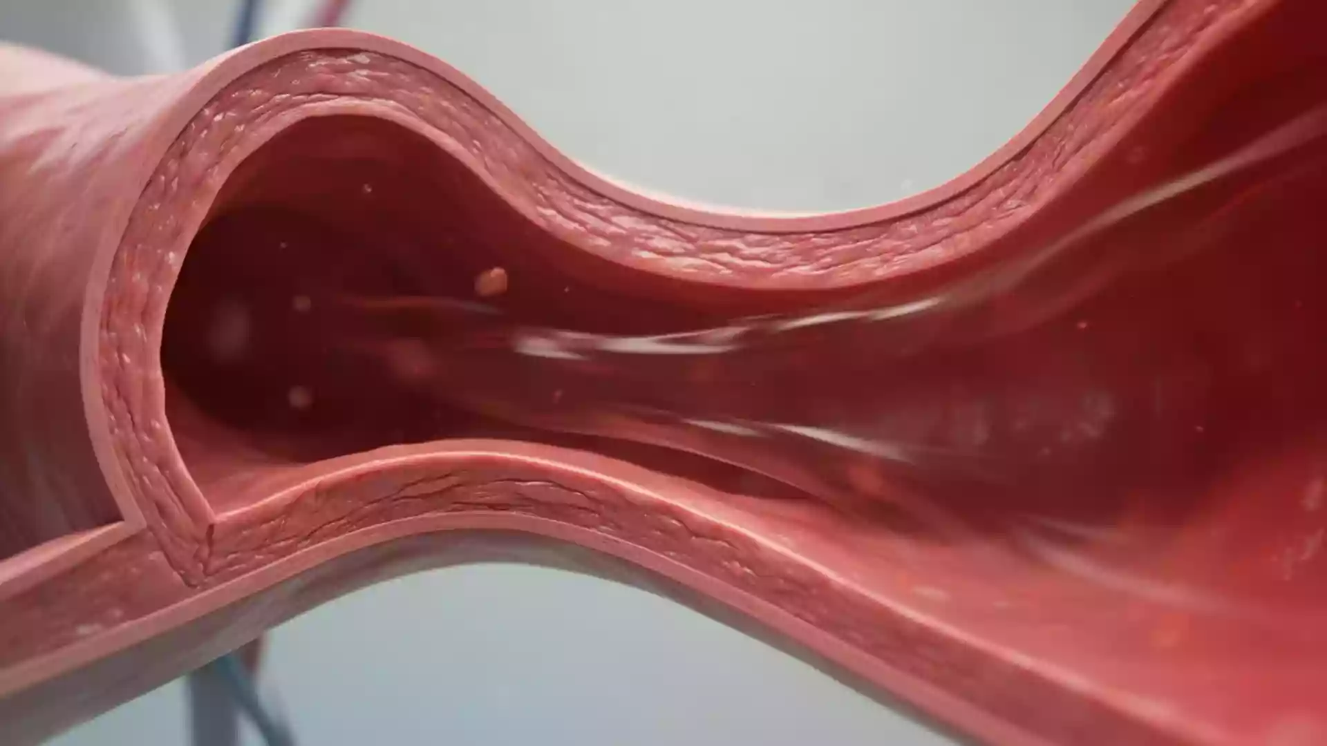 Lipid Experts Back Immediate Combination Therapy Over Stepwise Approach