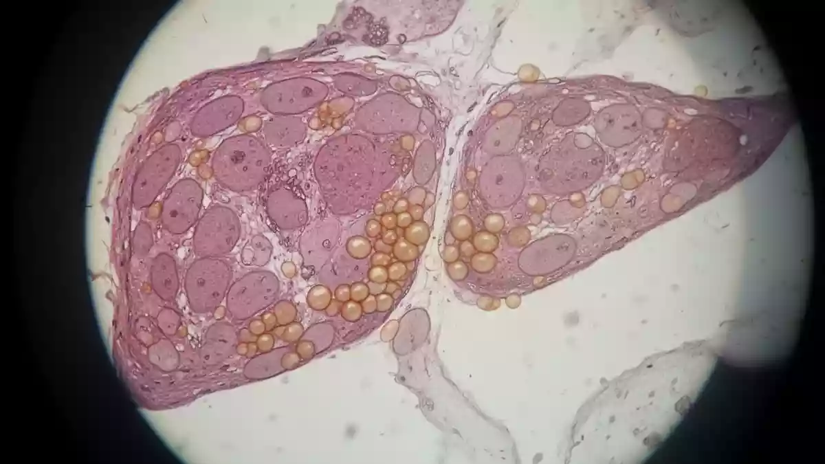 Mikroskopische Aufnahme von Lebergewebe zur Veranschaulichung der metabolischen Fettlebererkrankung. Illustration mit AI erstellt.