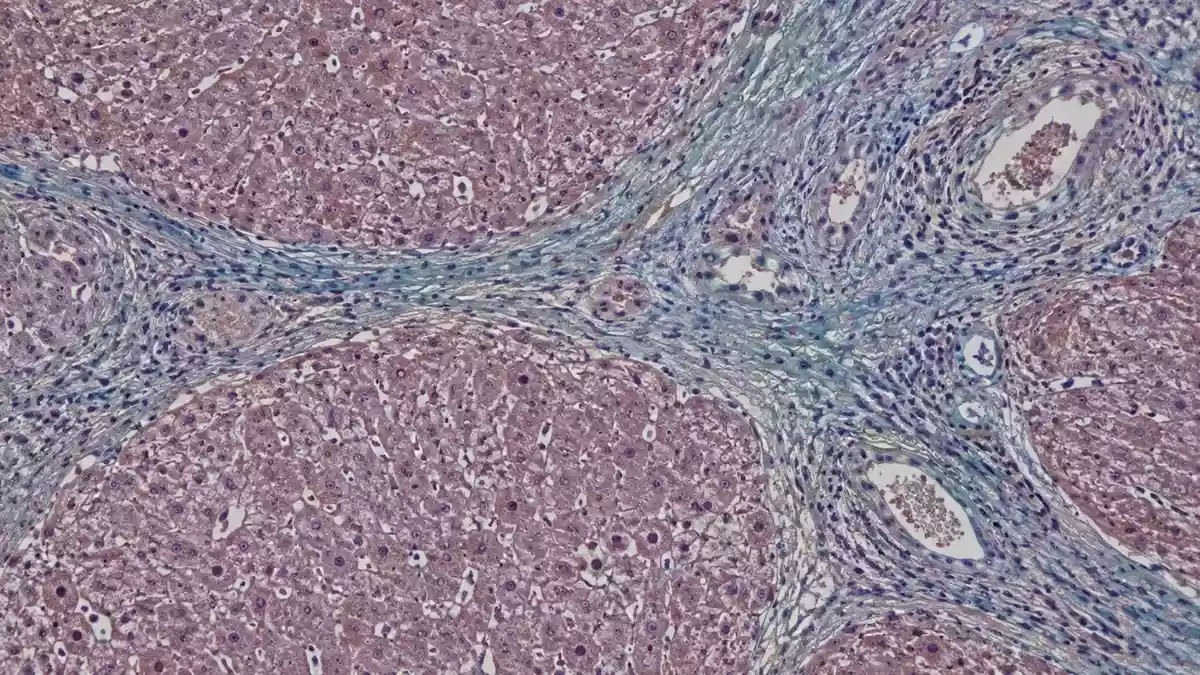 Mikroskopische Aufnahme von Lebergewebe mit Anzeichen einer Fibrose. Illustration mit AI erstellt.