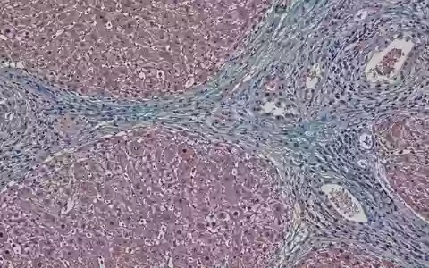 Mikroskopische Aufnahme von Lebergewebe mit Anzeichen einer Fibrose. - Foto: über boerse-global.de