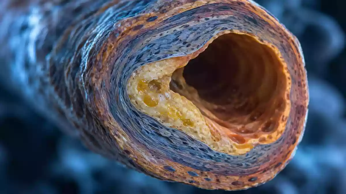 Mikroskopische Nahaufnahme einer Arterie mit Anzeichen von Gefäßveränderungen und Plaquebildung. Illustration mit AI erstellt.