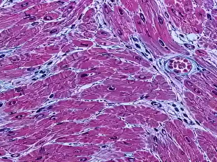 Mikroskopische Aufnahme von Herzmuskelgewebe mit erkennbaren zellulären Strukturen und entzündlichen Veränderungen. - Foto: über boerse-global.de