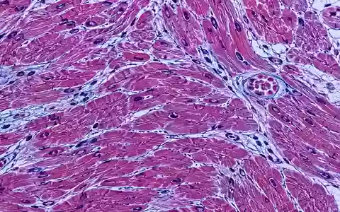 Mikroskopische Aufnahme von Herzmuskelgewebe mit erkennbaren zellulären Strukturen und entzündlichen Veränderungen. - Foto: über boerse-global.de