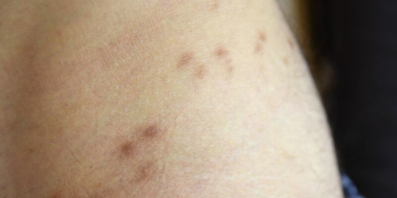 Krätze ist eine durch Milben verursachte ansteckende, nicht-tödliche Hautkrankheit. - Foto: Henning Kaiser/dpa